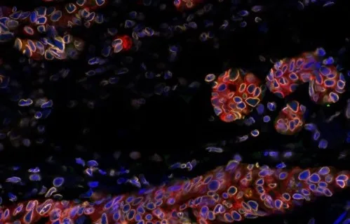 Rechutes du cancer du sein : découverte d’un mécanisme de résistance cellulaire clé