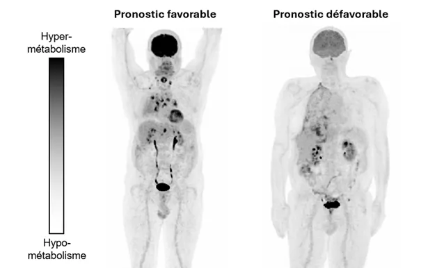 Métabolisme cérébral et cancer du poumon