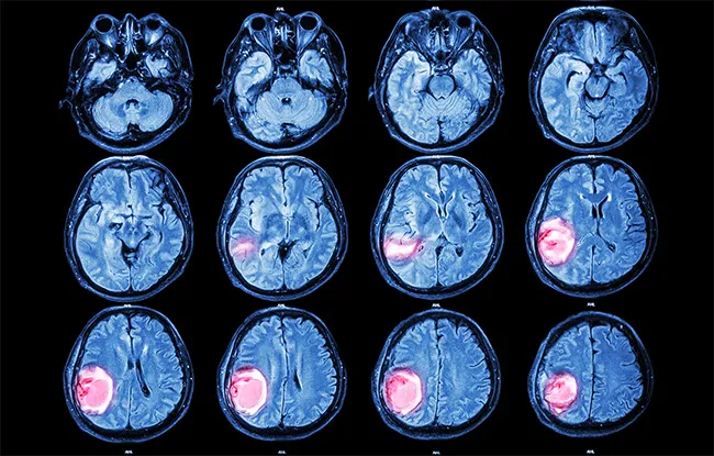 Cancers du système nerveux central